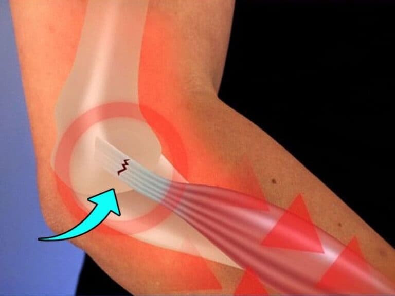 Cirurgia de Cotovelo